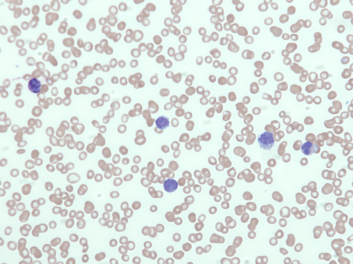 Peripheral blood, Wright Giemsa, 40x. At the more advanced stage of disease circulating blasts (10%) with monocytic morphologic features and an absolute monocytosis and basophilia are present.